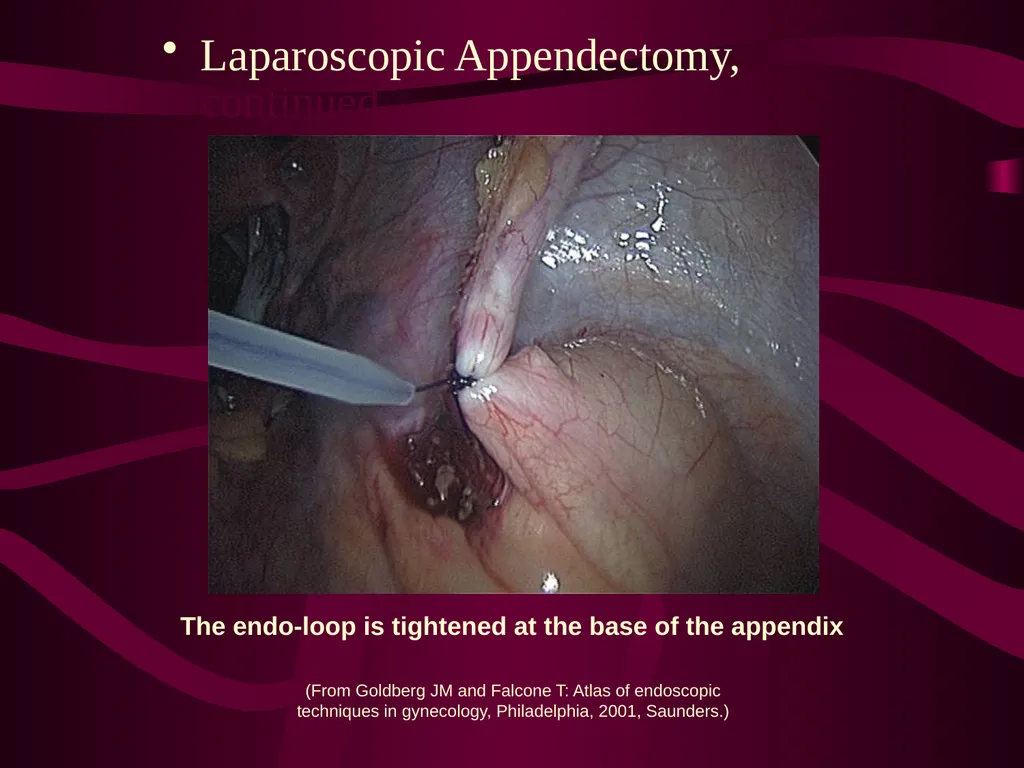 SUR 111 Tracheotomy/Tracheostomy Appendectomy - slide 24 of 28