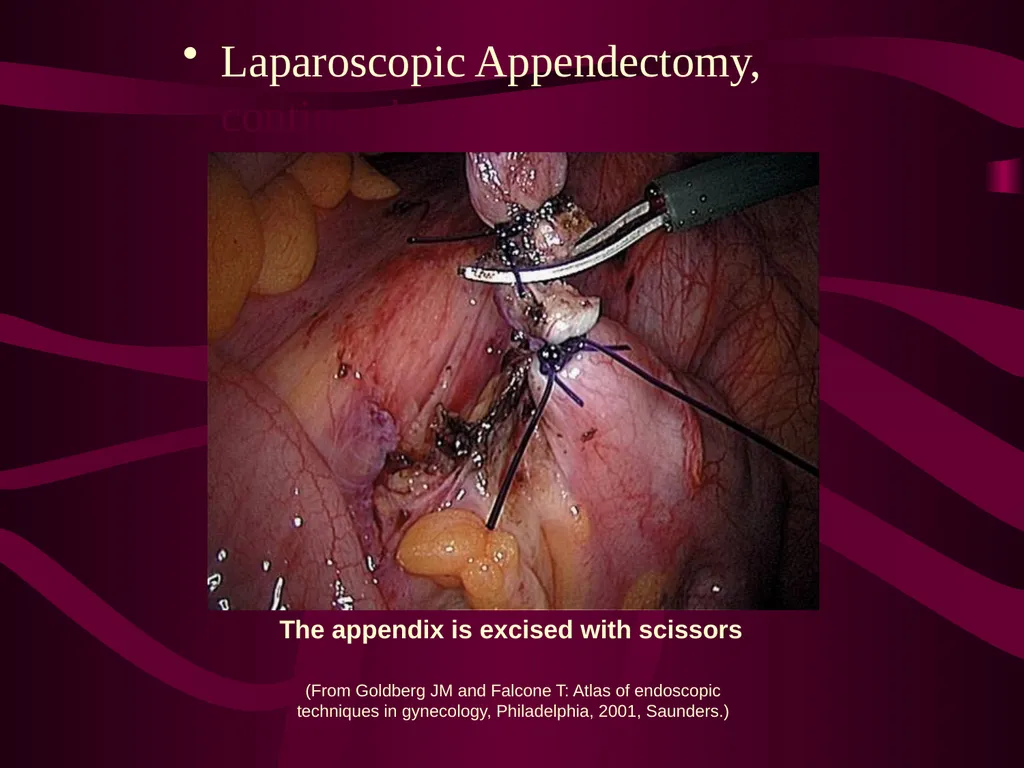 SUR 111 Tracheotomy/Tracheostomy Appendectomy - slide 26 of 28