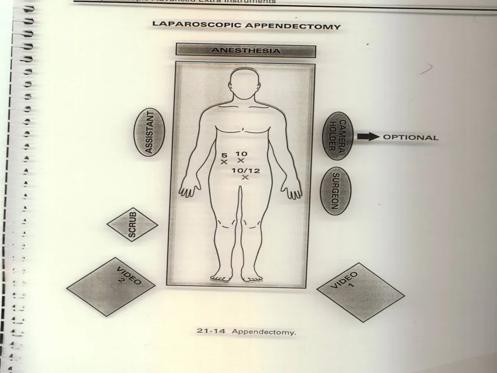 SUR 111 Tracheotomy/Tracheostomy Appendectomy - slide 21 of 28