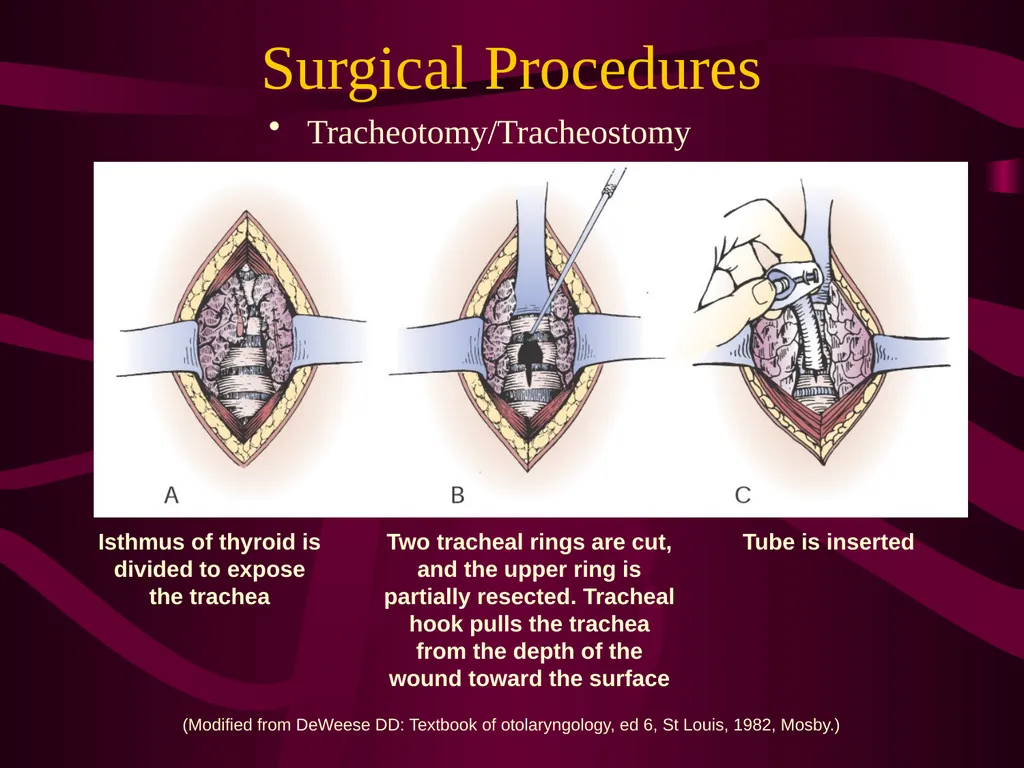 SUR 111 Tracheotomy/Tracheostomy Appendectomy - slide 15 of 28