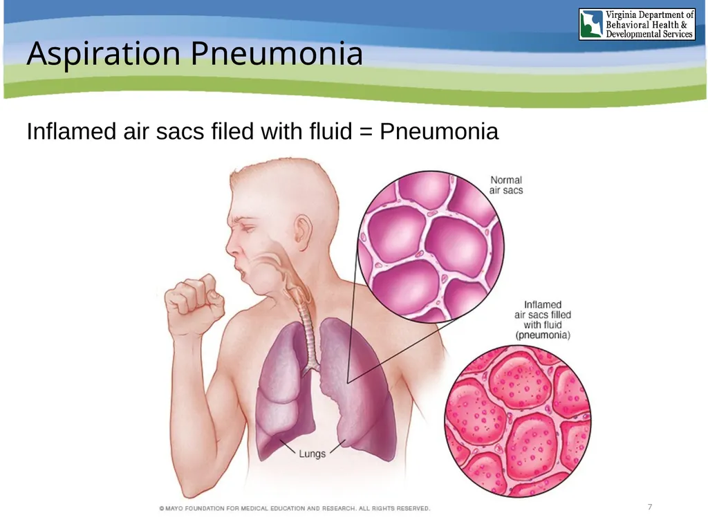 Aspiration Pneumonia Risk Awareness Training (RAT) - slide 7 of 26
