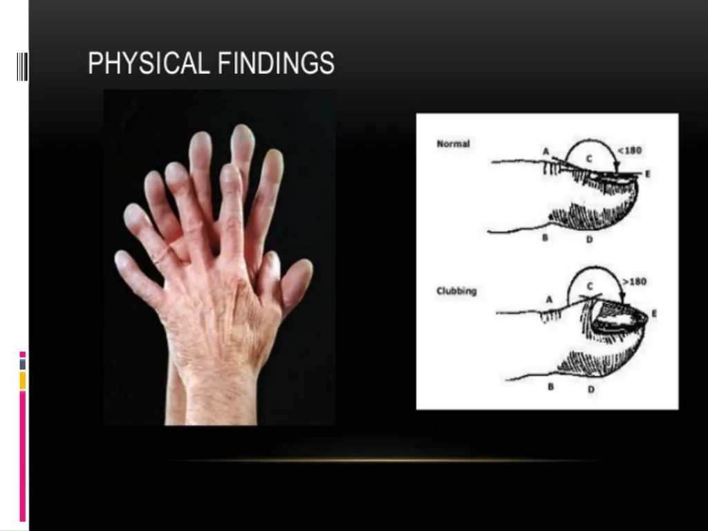 APPROCH TO THE PT WITH INTERSTITIAL LUNG DISEASE - slide 12 of 80