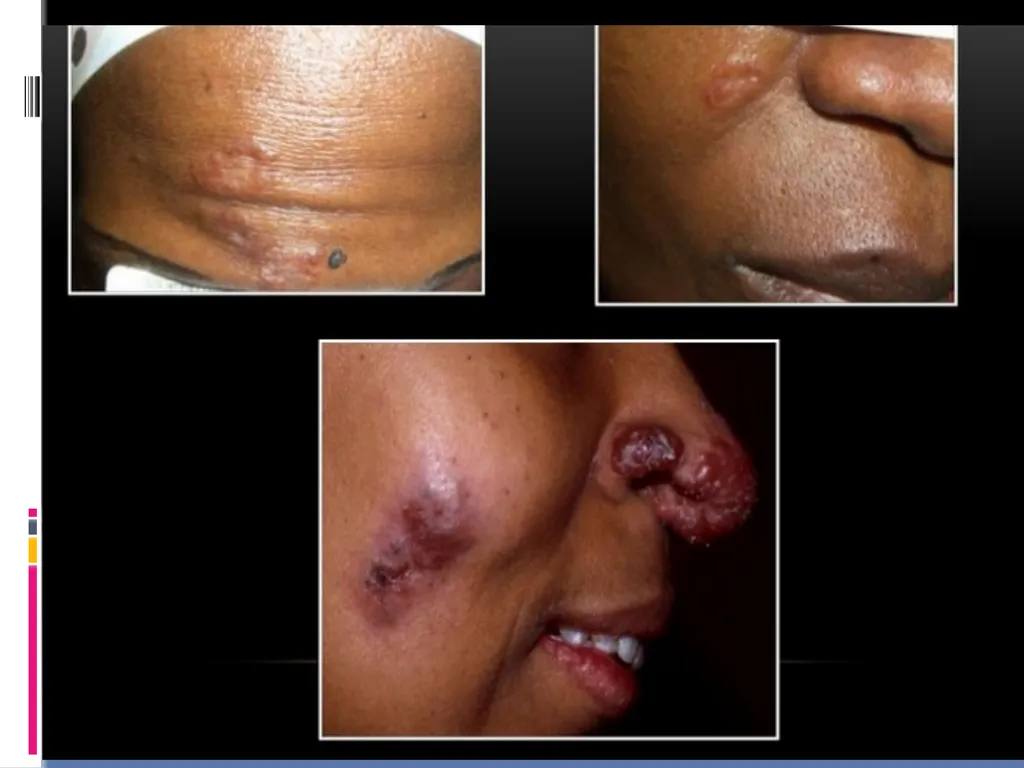 APPROCH TO THE PT WITH INTERSTITIAL LUNG DISEASE - slide 13 of 80