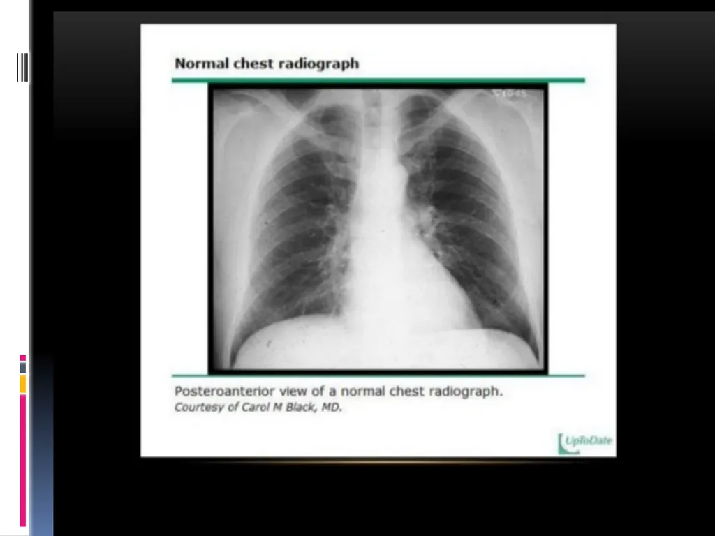 APPROCH TO THE PT WITH INTERSTITIAL LUNG DISEASE - slide 22 of 80