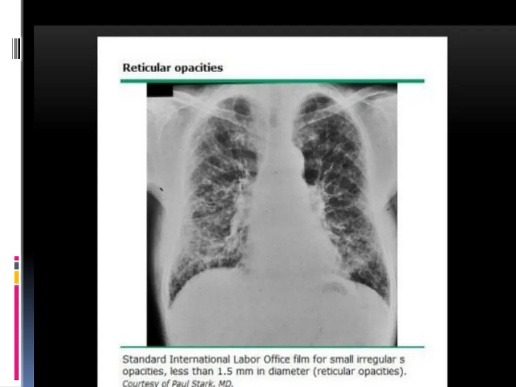 APPROCH TO THE PT WITH INTERSTITIAL LUNG DISEASE - slide 23 of 80