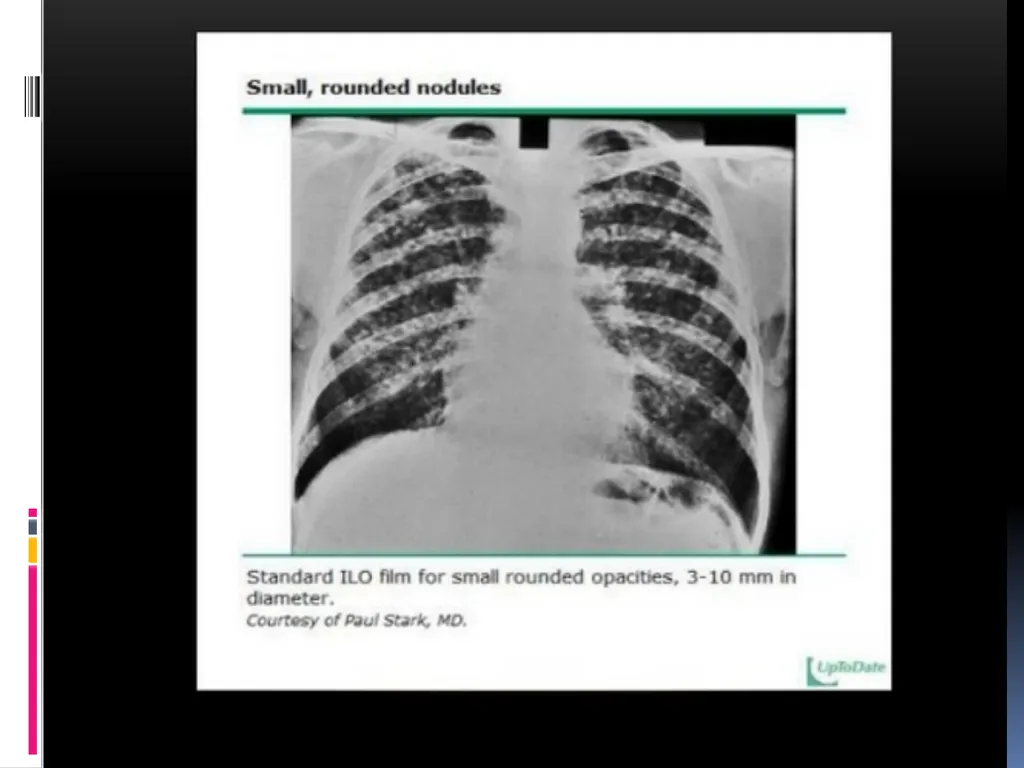 APPROCH TO THE PT WITH INTERSTITIAL LUNG DISEASE - slide 24 of 80