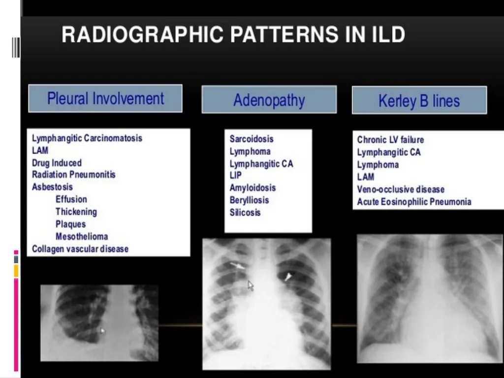 APPROCH TO THE PT WITH INTERSTITIAL LUNG DISEASE - slide 25 of 80