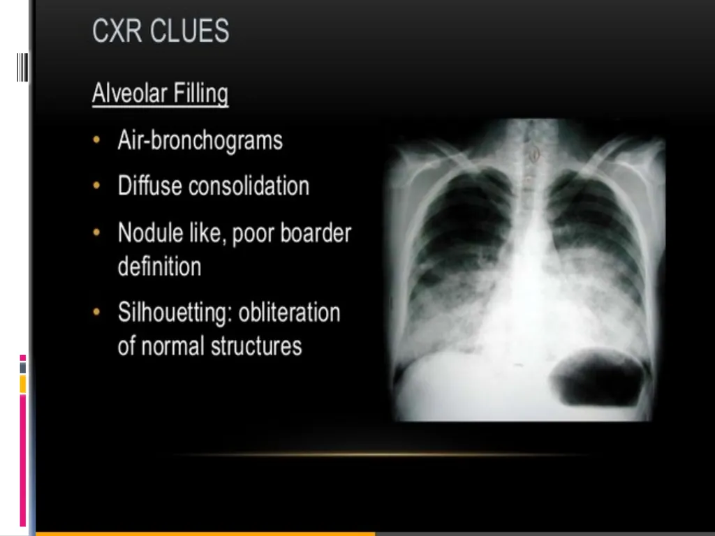 APPROCH TO THE PT WITH INTERSTITIAL LUNG DISEASE - slide 26 of 80