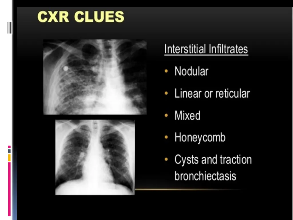 APPROCH TO THE PT WITH INTERSTITIAL LUNG DISEASE - slide 27 of 80