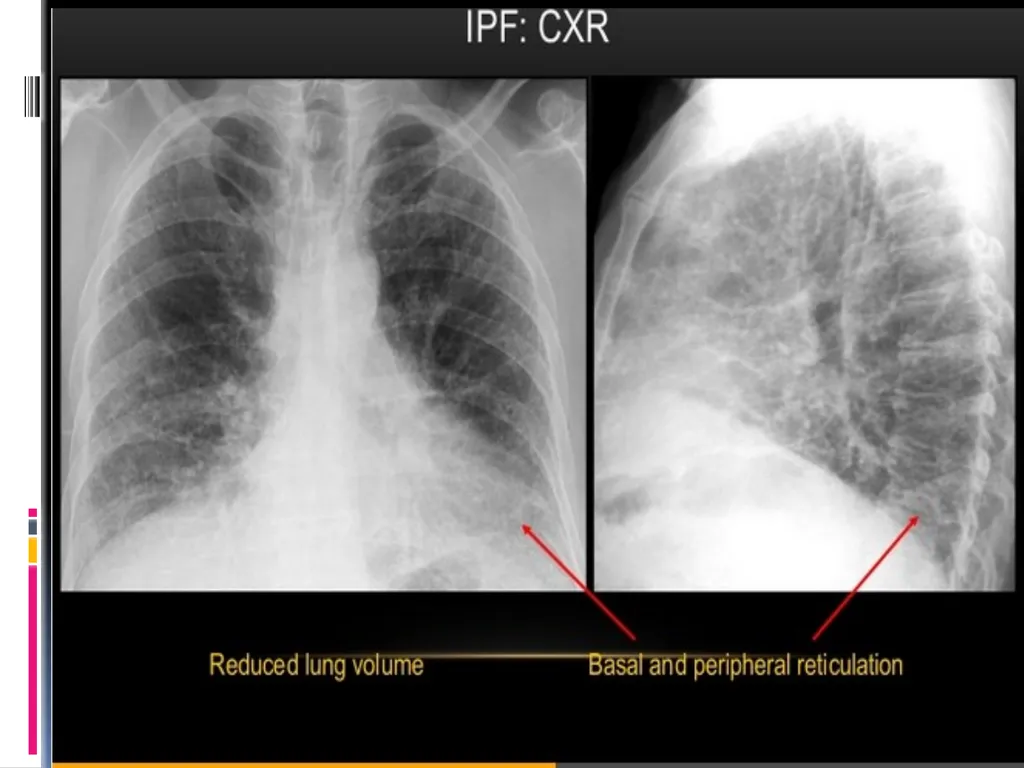 APPROCH TO THE PT WITH INTERSTITIAL LUNG DISEASE - slide 28 of 80
