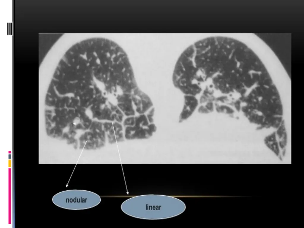 APPROCH TO THE PT WITH INTERSTITIAL LUNG DISEASE - slide 31 of 80