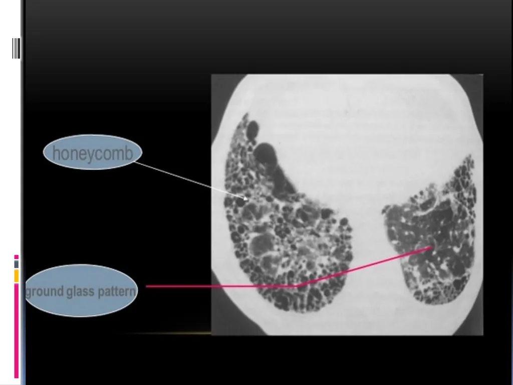 APPROCH TO THE PT WITH INTERSTITIAL LUNG DISEASE - slide 32 of 80
