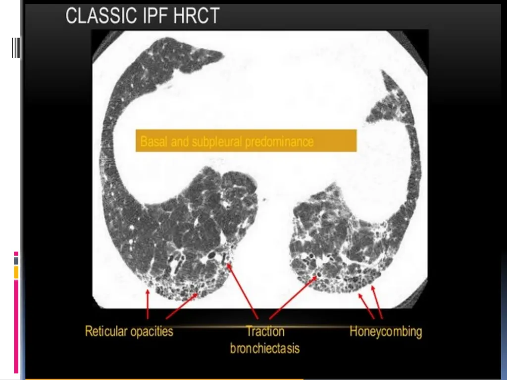 APPROCH TO THE PT WITH INTERSTITIAL LUNG DISEASE - slide 33 of 80