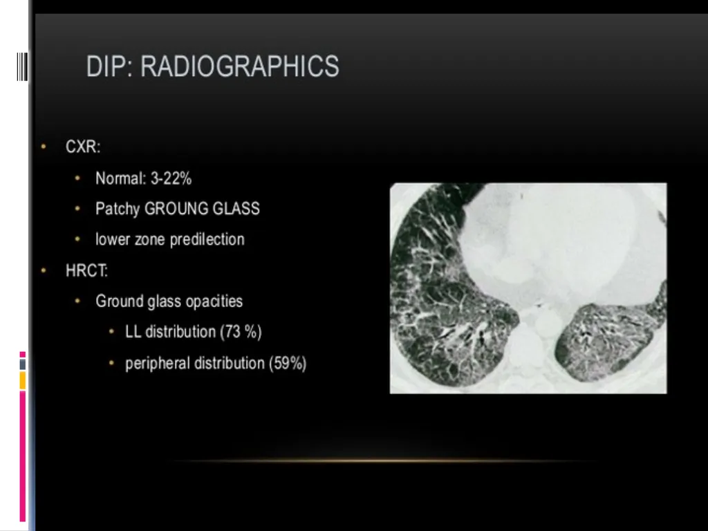 APPROCH TO THE PT WITH INTERSTITIAL LUNG DISEASE - slide 36 of 80