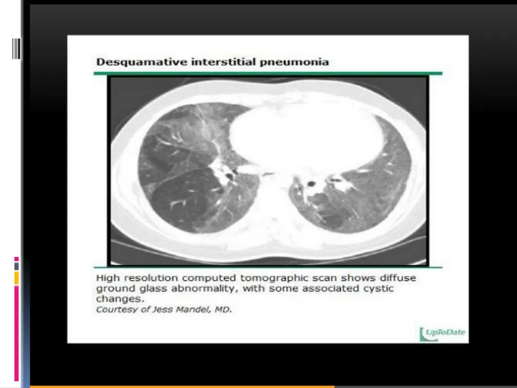 APPROCH TO THE PT WITH INTERSTITIAL LUNG DISEASE - slide 37 of 80