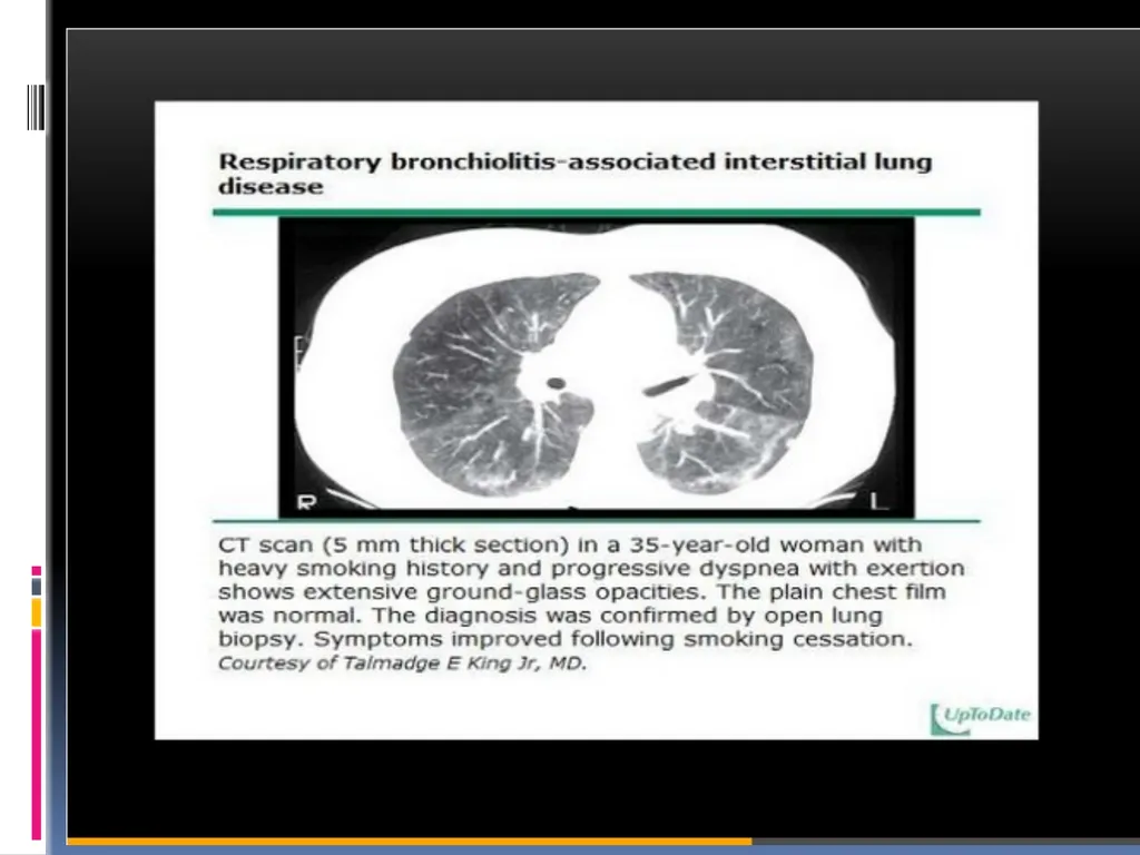 APPROCH TO THE PT WITH INTERSTITIAL LUNG DISEASE - slide 38 of 80