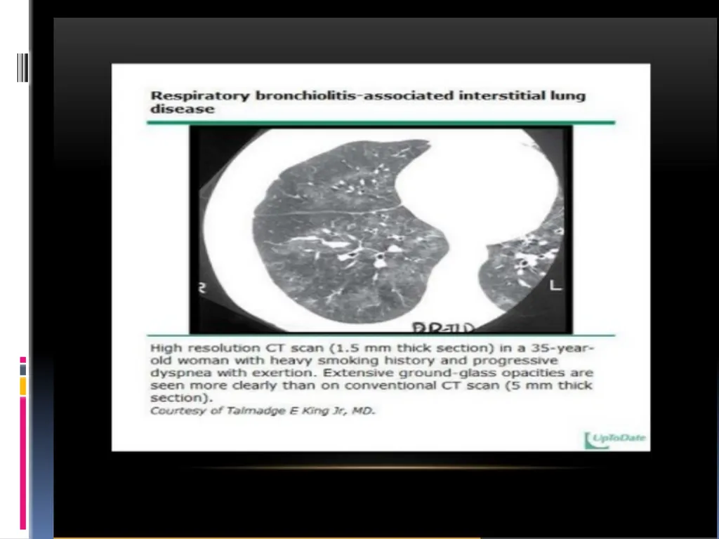 APPROCH TO THE PT WITH INTERSTITIAL LUNG DISEASE - slide 39 of 80