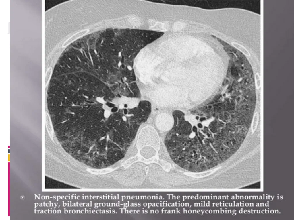 APPROCH TO THE PT WITH INTERSTITIAL LUNG DISEASE - slide 40 of 80