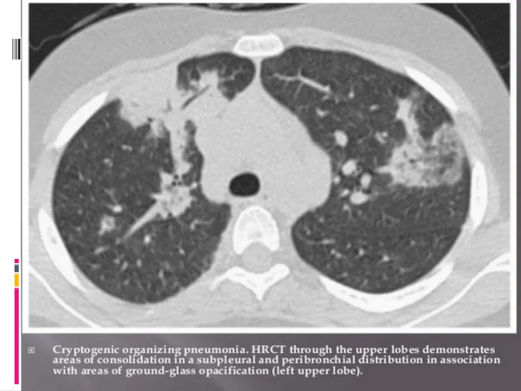 APPROCH TO THE PT WITH INTERSTITIAL LUNG DISEASE - slide 42 of 80