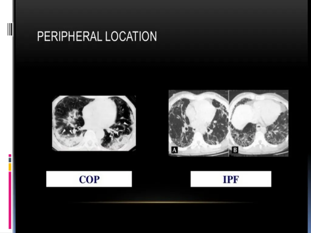 APPROCH TO THE PT WITH INTERSTITIAL LUNG DISEASE - slide 43 of 80