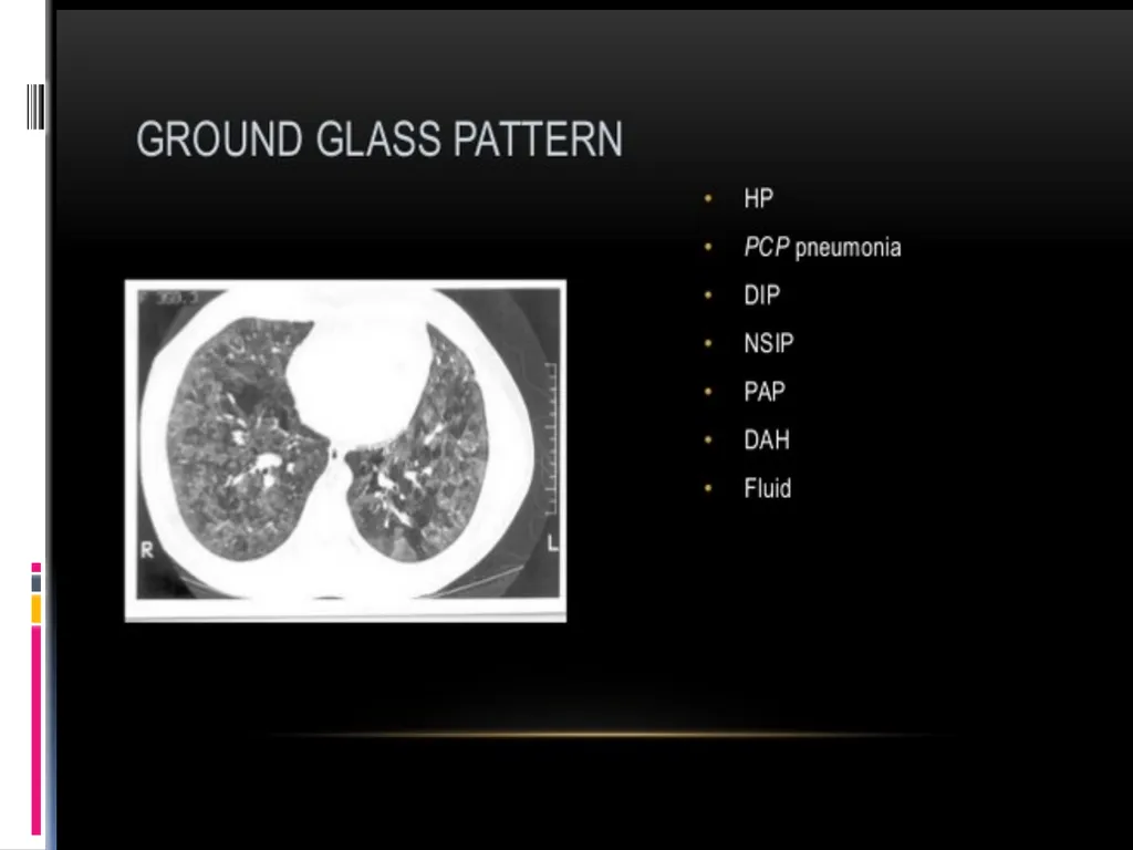 APPROCH TO THE PT WITH INTERSTITIAL LUNG DISEASE - slide 45 of 80
