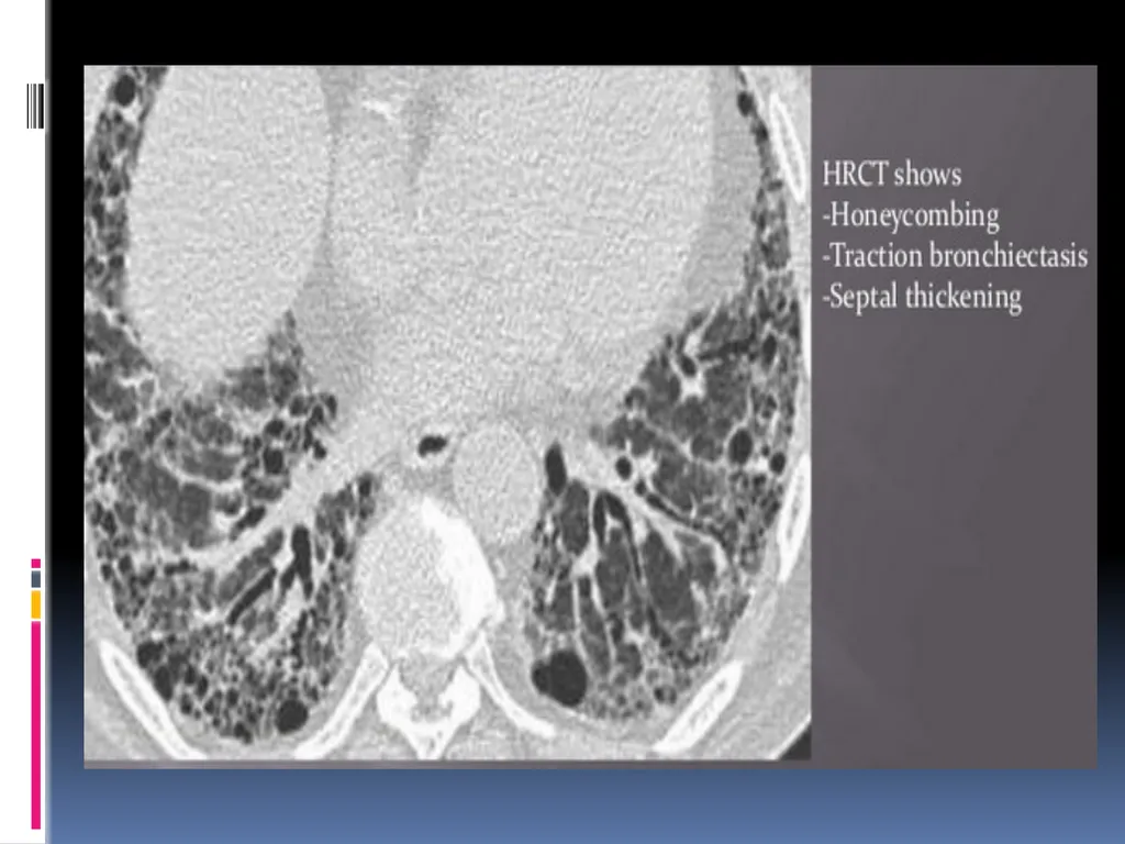 APPROCH TO THE PT WITH INTERSTITIAL LUNG DISEASE - slide 72 of 80