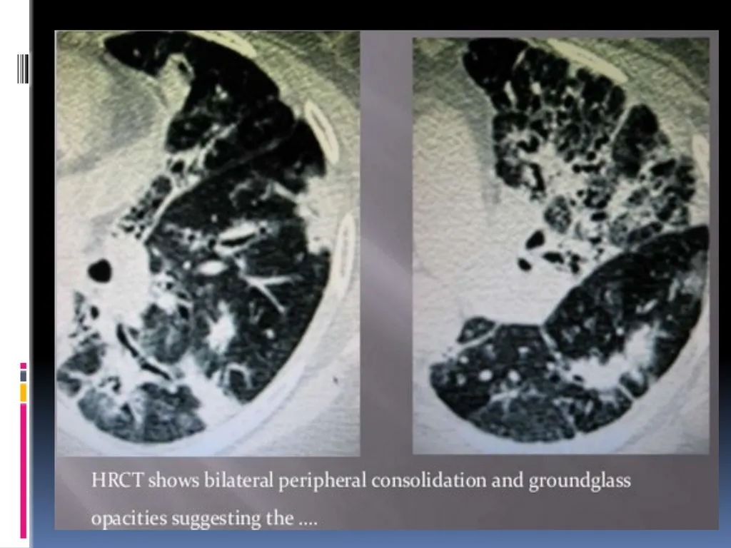 APPROCH TO THE PT WITH INTERSTITIAL LUNG DISEASE - slide 75 of 80