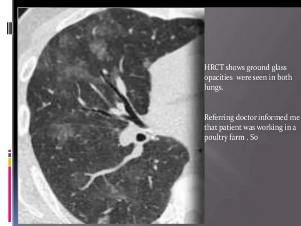 APPROCH TO THE PT WITH INTERSTITIAL LUNG DISEASE - slide 78 of 80