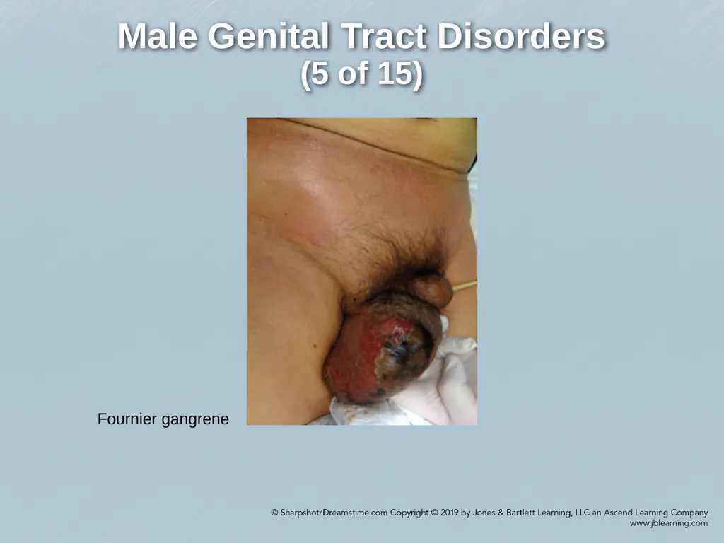 Chapter 29 Genitourinary and Renal Disorders - slide 40 of 52