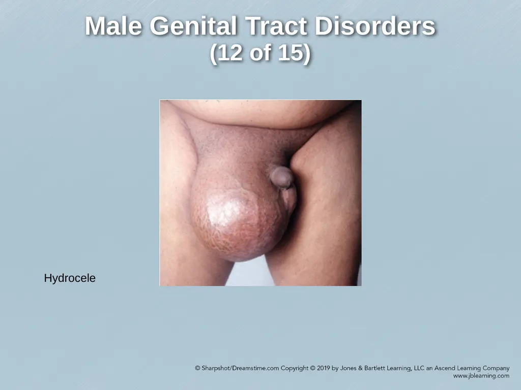 Chapter 29 Genitourinary and Renal Disorders - slide 47 of 52