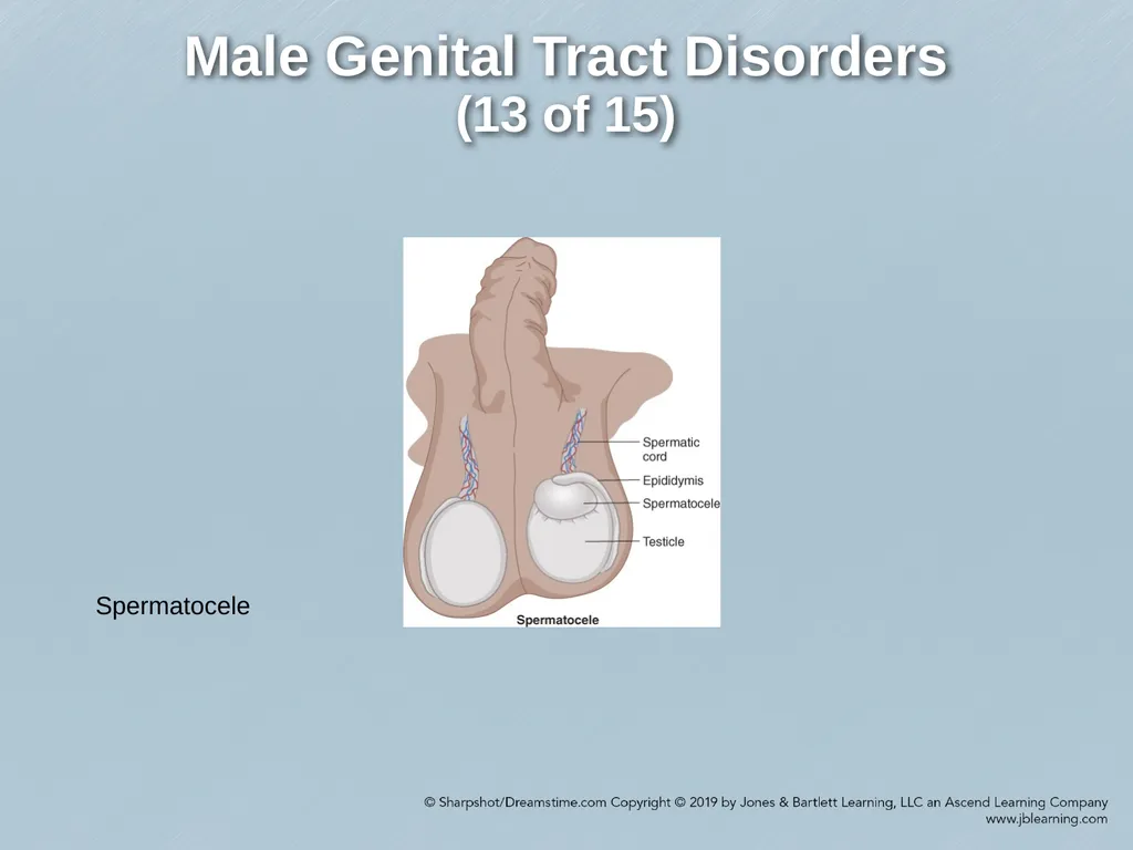Chapter 29 Genitourinary and Renal Disorders - slide 48 of 52
