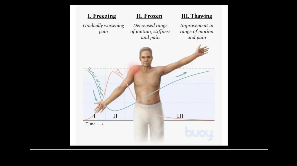 Frozen shoulder Faculty of Medicine, Rzeszów - slide 7 of 13
