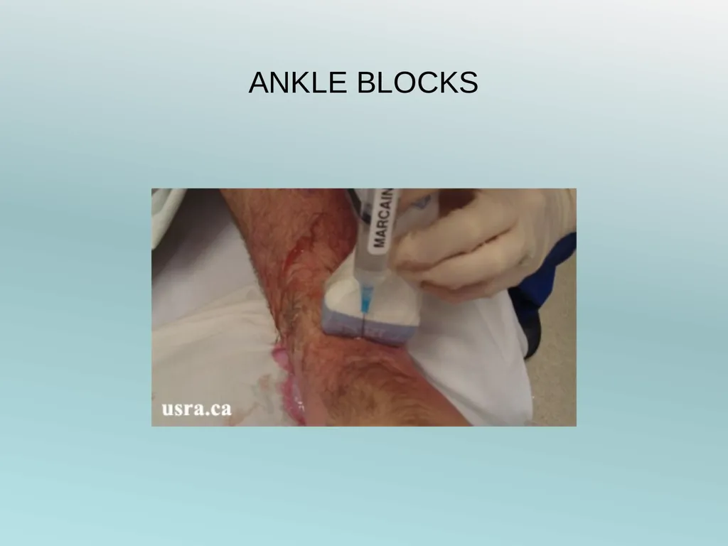 Surgery Under Regional Anesthesia Jean Daniel - slide 62 of 76