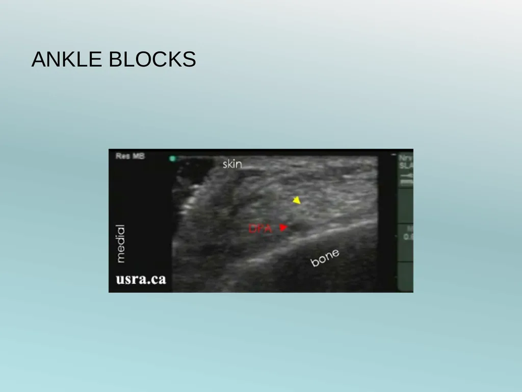Surgery Under Regional Anesthesia Jean Daniel - slide 63 of 76