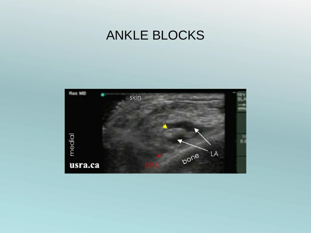 Surgery Under Regional Anesthesia Jean Daniel - slide 64 of 76
