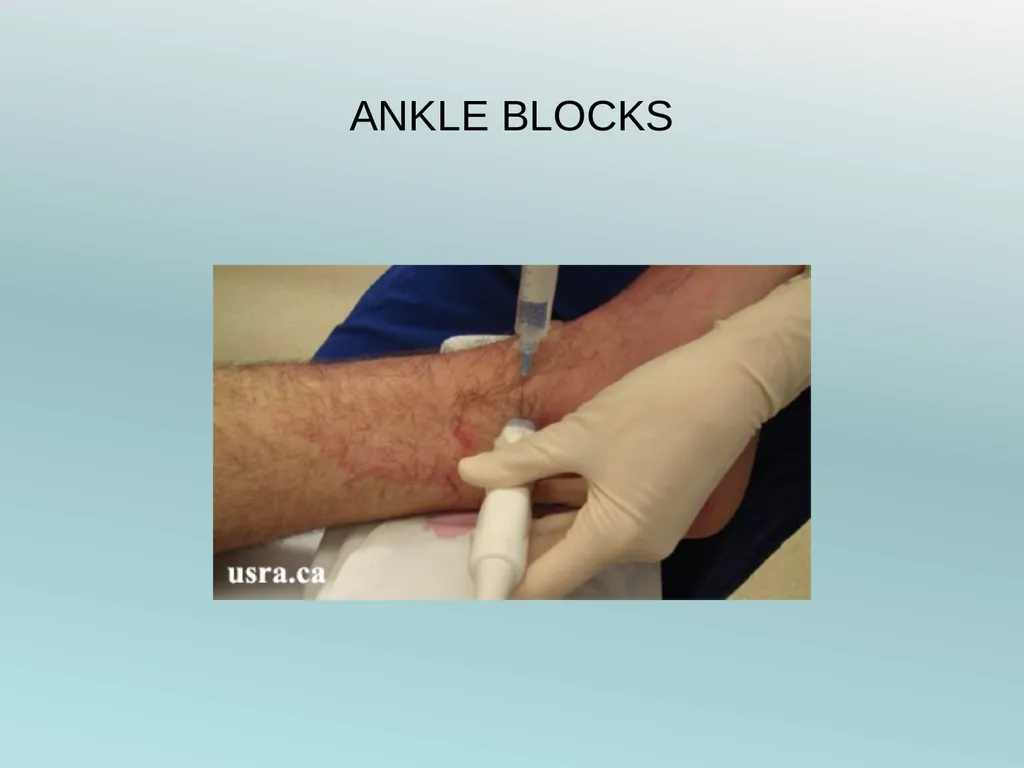 Surgery Under Regional Anesthesia Jean Daniel - slide 65 of 76