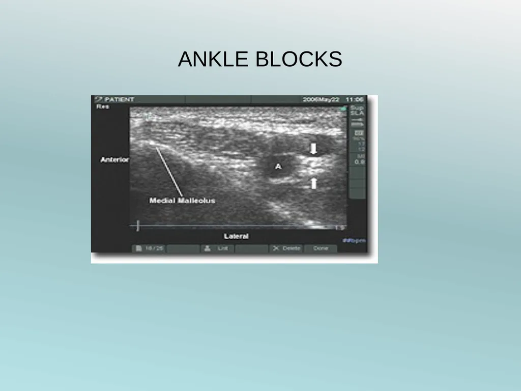 Surgery Under Regional Anesthesia Jean Daniel - slide 66 of 76