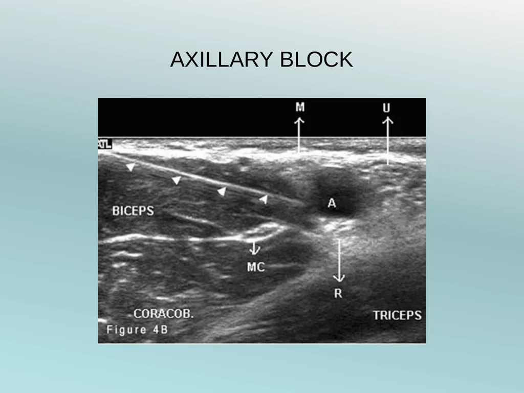 Surgery Under Regional Anesthesia Jean Daniel - slide 30 of 76