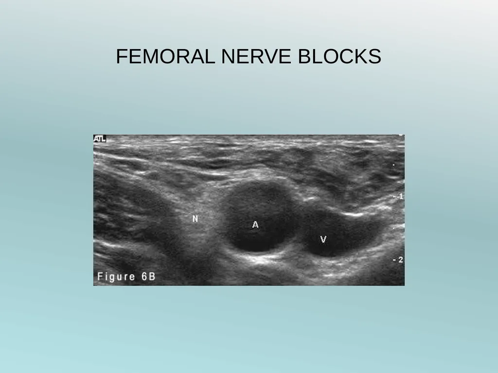 Surgery Under Regional Anesthesia Jean Daniel - slide 45 of 76