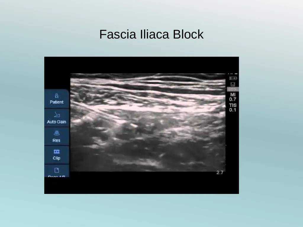 Surgery Under Regional Anesthesia Jean Daniel - slide 41 of 76