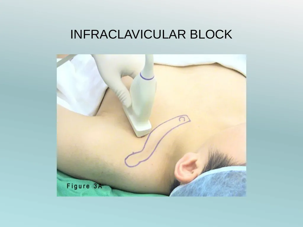 Surgery Under Regional Anesthesia Jean Daniel - slide 24 of 76