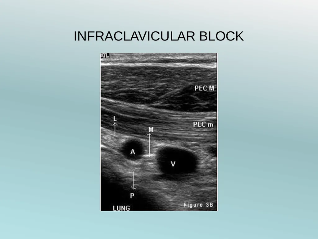 Surgery Under Regional Anesthesia Jean Daniel - slide 25 of 76