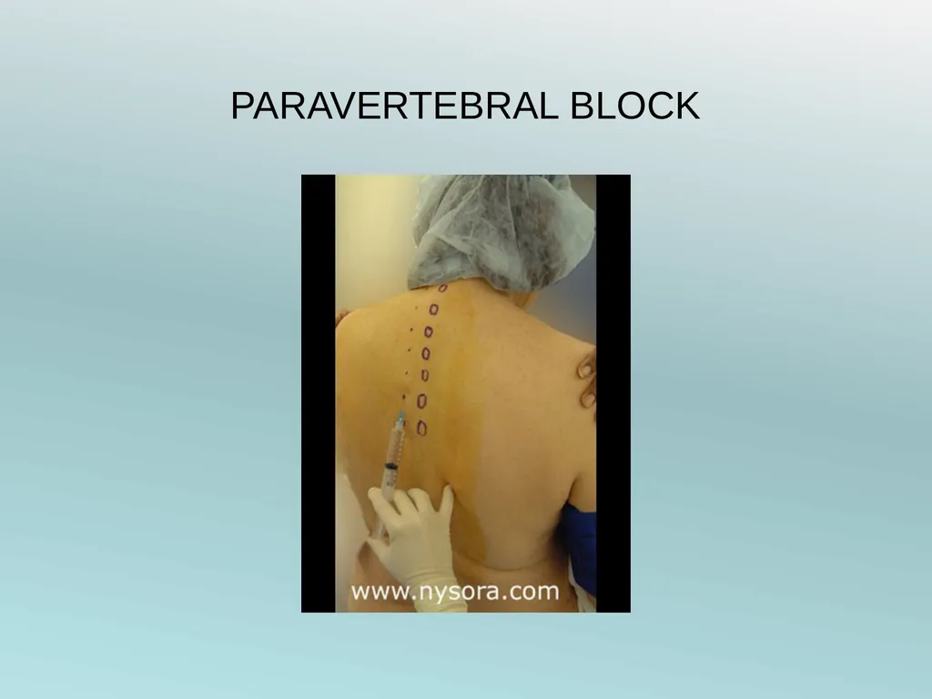 Surgery Under Regional Anesthesia Jean Daniel - slide 73 of 76