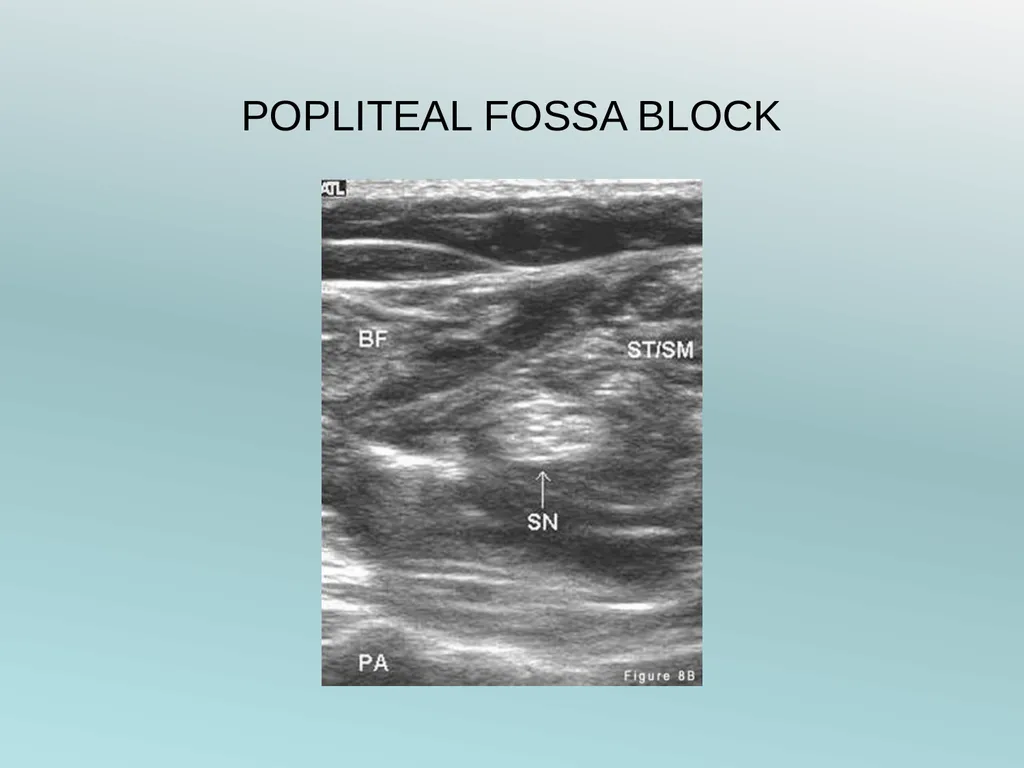 Surgery Under Regional Anesthesia Jean Daniel - slide 57 of 76