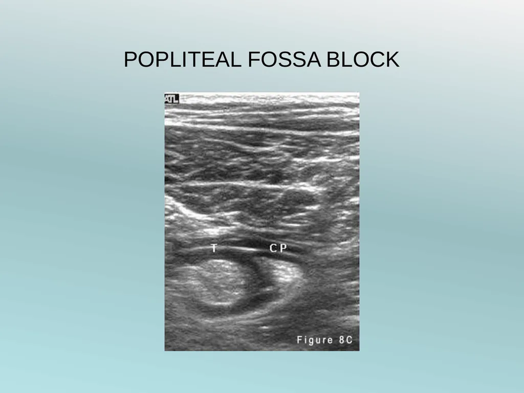 Surgery Under Regional Anesthesia Jean Daniel - slide 58 of 76