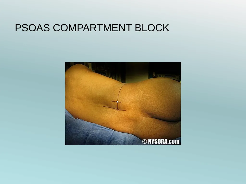 Surgery Under Regional Anesthesia Jean Daniel - slide 36 of 76
