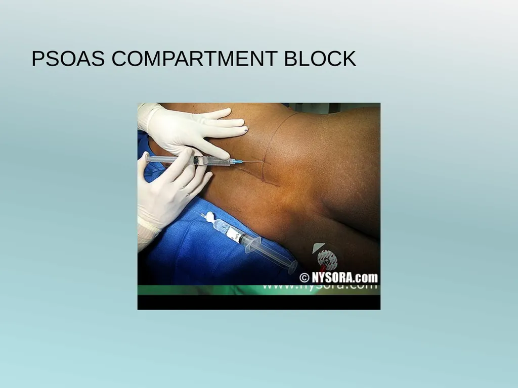 Surgery Under Regional Anesthesia Jean Daniel - slide 37 of 76