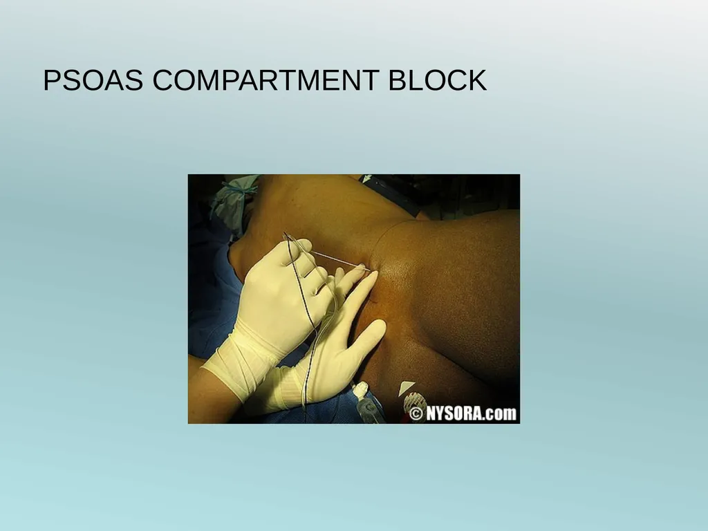 Surgery Under Regional Anesthesia Jean Daniel - slide 38 of 76