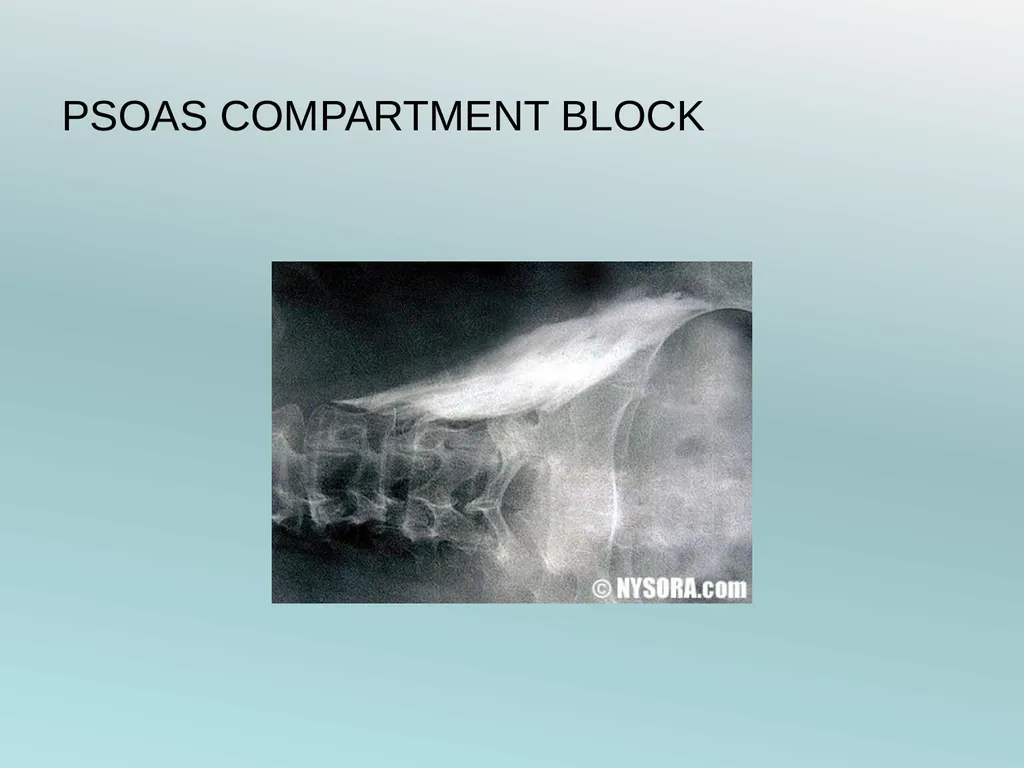 Surgery Under Regional Anesthesia Jean Daniel - slide 39 of 76