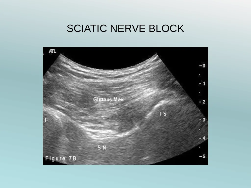 Surgery Under Regional Anesthesia Jean Daniel - slide 48 of 76